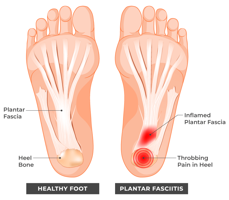 Plantar Fasciitis Exercises: 10 Steps To Help Relieve Pain