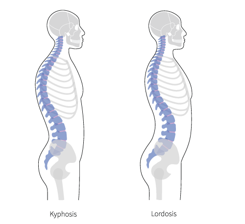 Diagram shows a healthy spinal curve versus the unhealthy exaggerate curve of spinal kyphosis