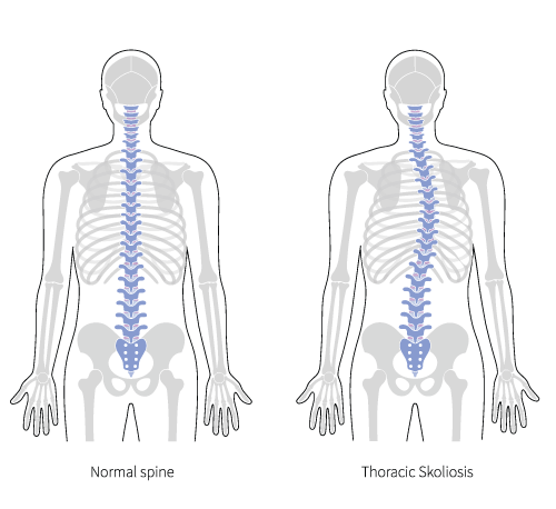 Diagram shows a healthy spinal curve versus the unhealthy exaggerate curve of spinal lordosis